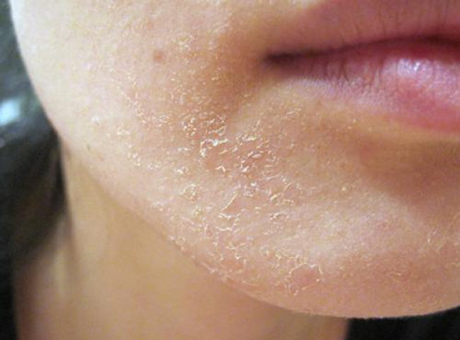 Da mặt bị mốc là bệnh gì?
