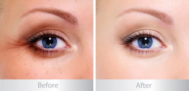 Bạn có thực sự cần dùng đến kem mắt?