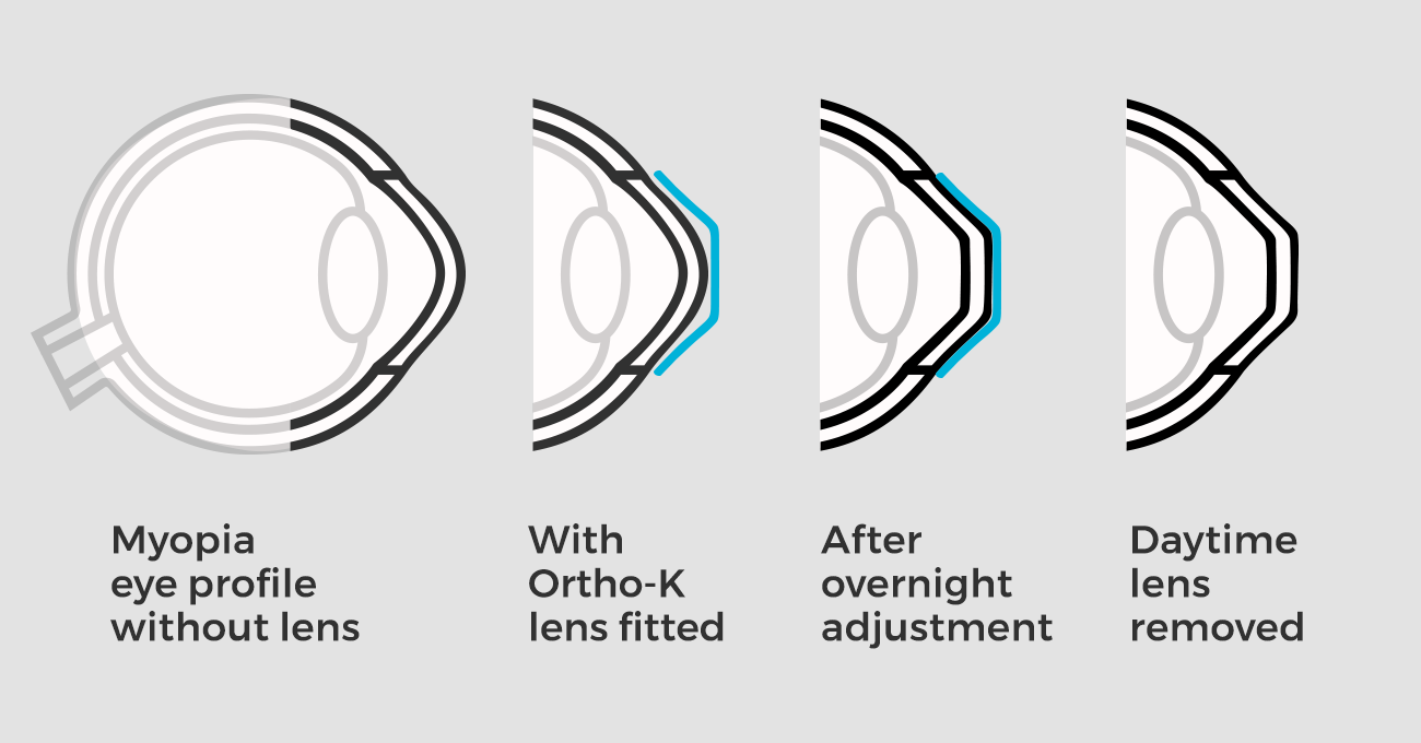 Kính Ortho-K với cơ chế đặc biệt, điều chỉnh giác mạc vào mỗi đêm