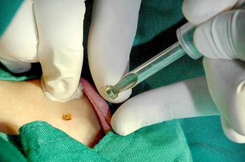 tiểu phẫu cắt bỏ mụn cóc