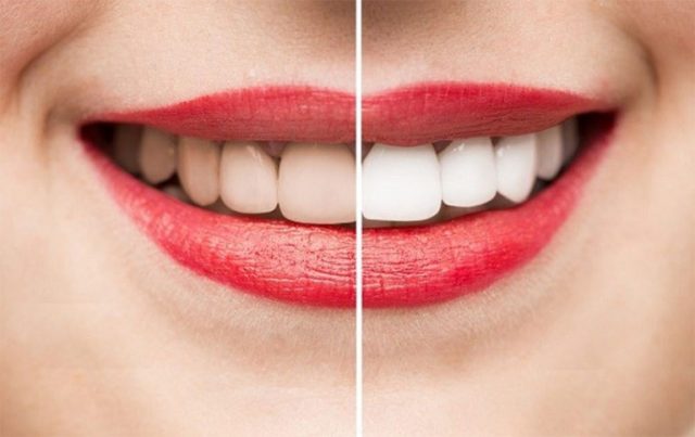 6 thói quen xấu khiến răng đổi màu và cách làm trắng răng không gây đau đớn
