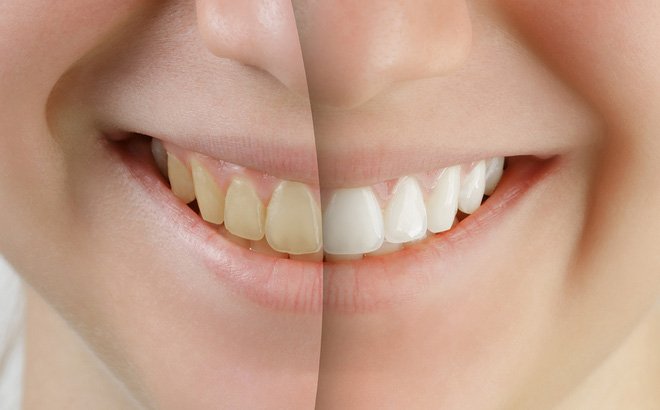 Một số lý do có thể khiến răng ố vàng, xỉn màu và 6 Cách tẩy trắng răng tự nhiên tại nhà
