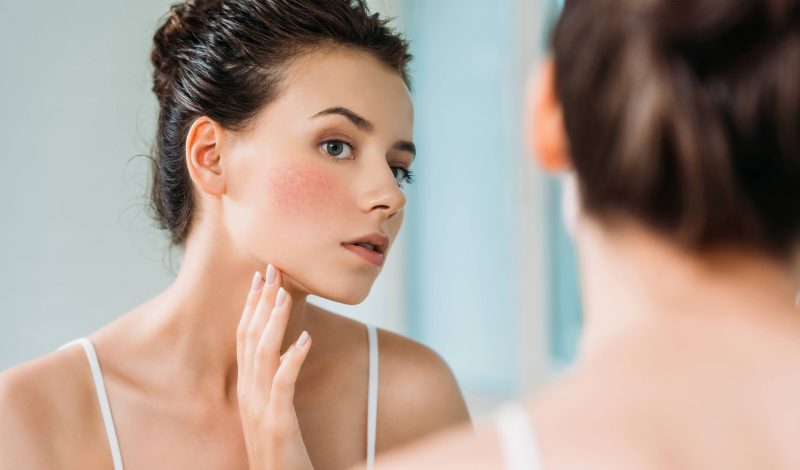 Top 5 sản phẩm chăm sóc da có thể xoa dịu làn da dị ứng hiệu quả