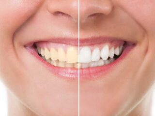 Cách làm trắng răng an toàn và hiệu quả