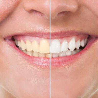 Cách làm trắng răng an toàn và hiệu quả