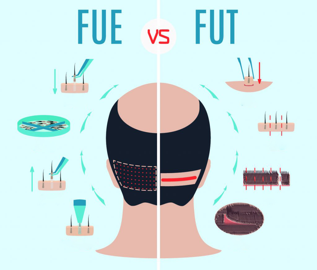 Phương pháp cấy tóc tự thân FUT