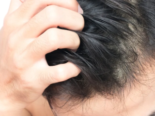 khắc phục da đầu ngứa ở nam giới